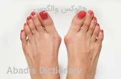 هالوکس والگوس